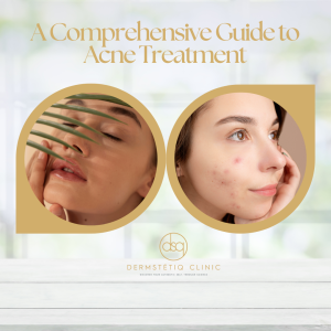 Acne Treatment: Unleash Your Best Skin Ever