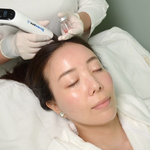 Best Hair Loss Treatment - Dermstetiq Clinic Singapore